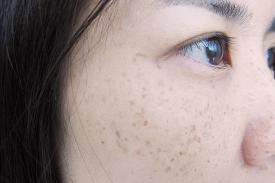 Tips Perawatan Kulit dengan Flek Hitam